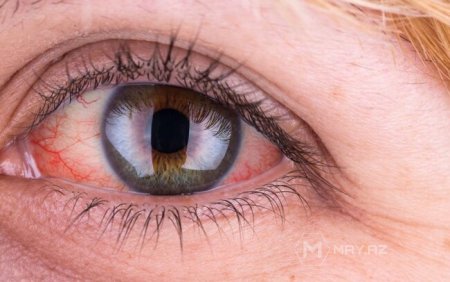 Göz qızartısının səbəbi nədir? – BU XƏSTƏLİKLƏRİN XƏBƏRÇİSİDİR